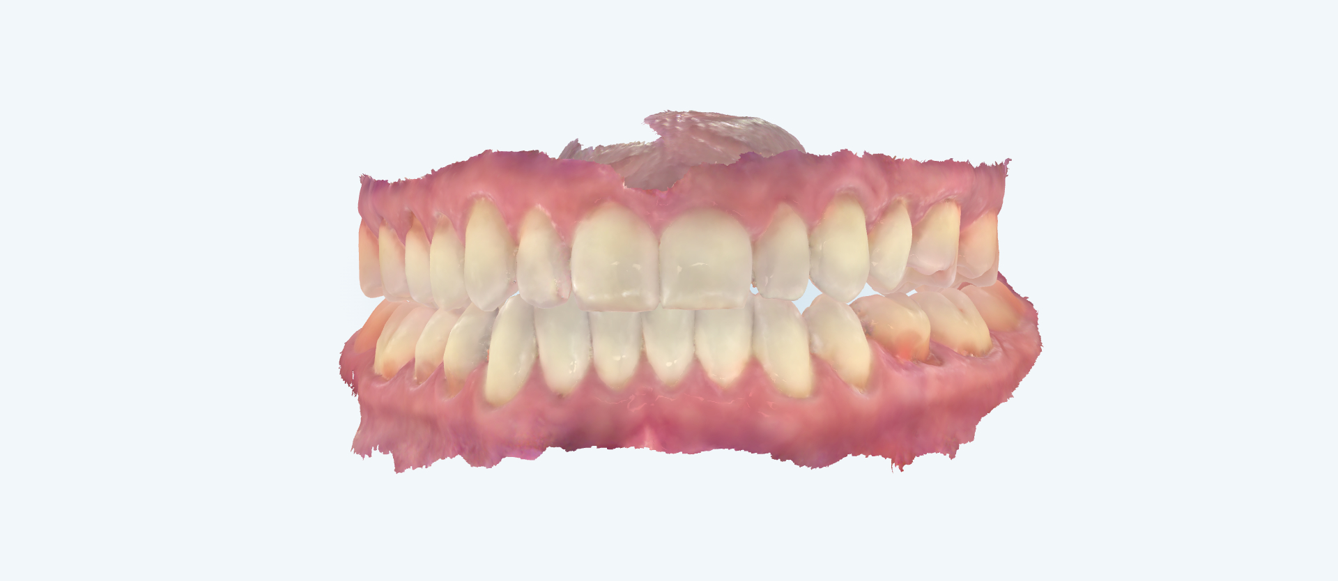 Underbite treatment comparison side view after